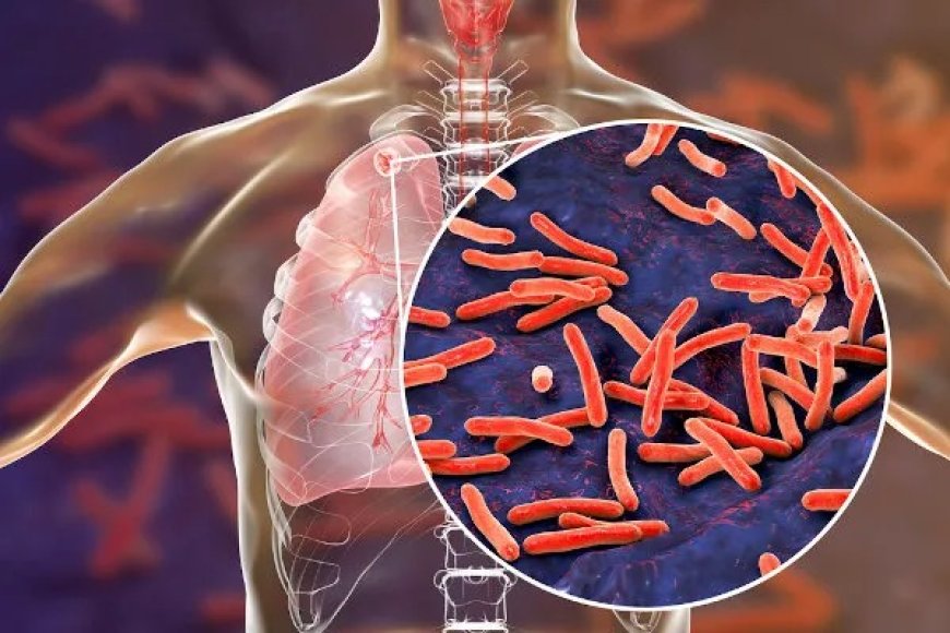 MPPR recomenda que administração de Paranaguá adote medidas para evitar expansão de casos de tuberculose